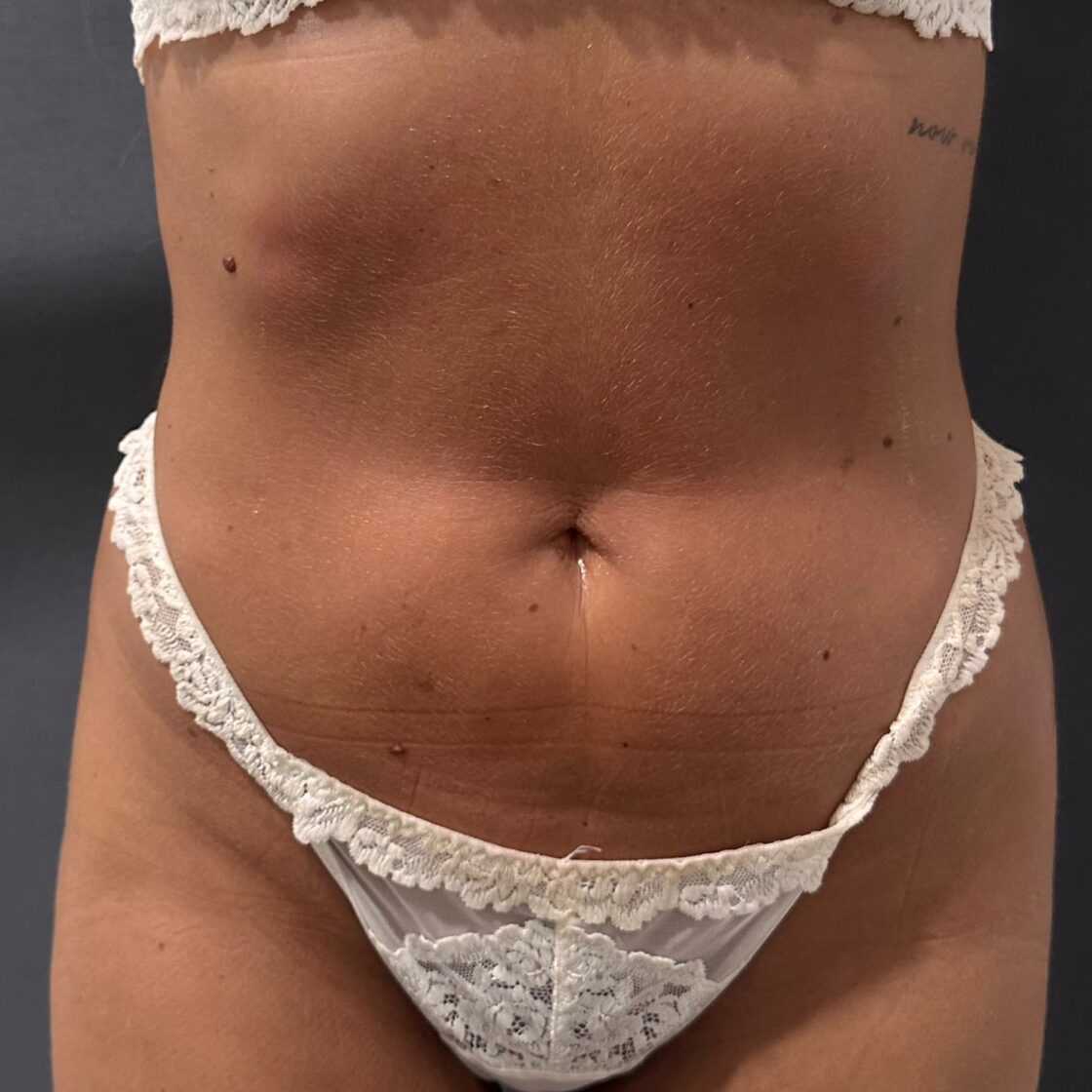 Después: Tratamiento corporal con carboxiterapia