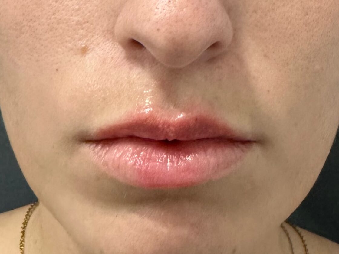 Después: Relleno y perfilado de labios con ácido hialurónico